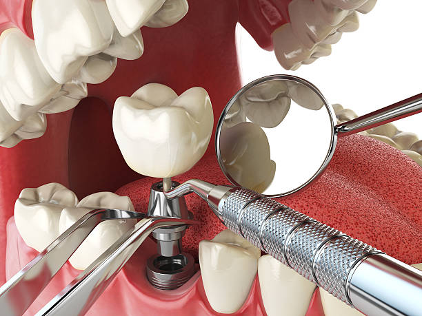Teeth Whitening in MT